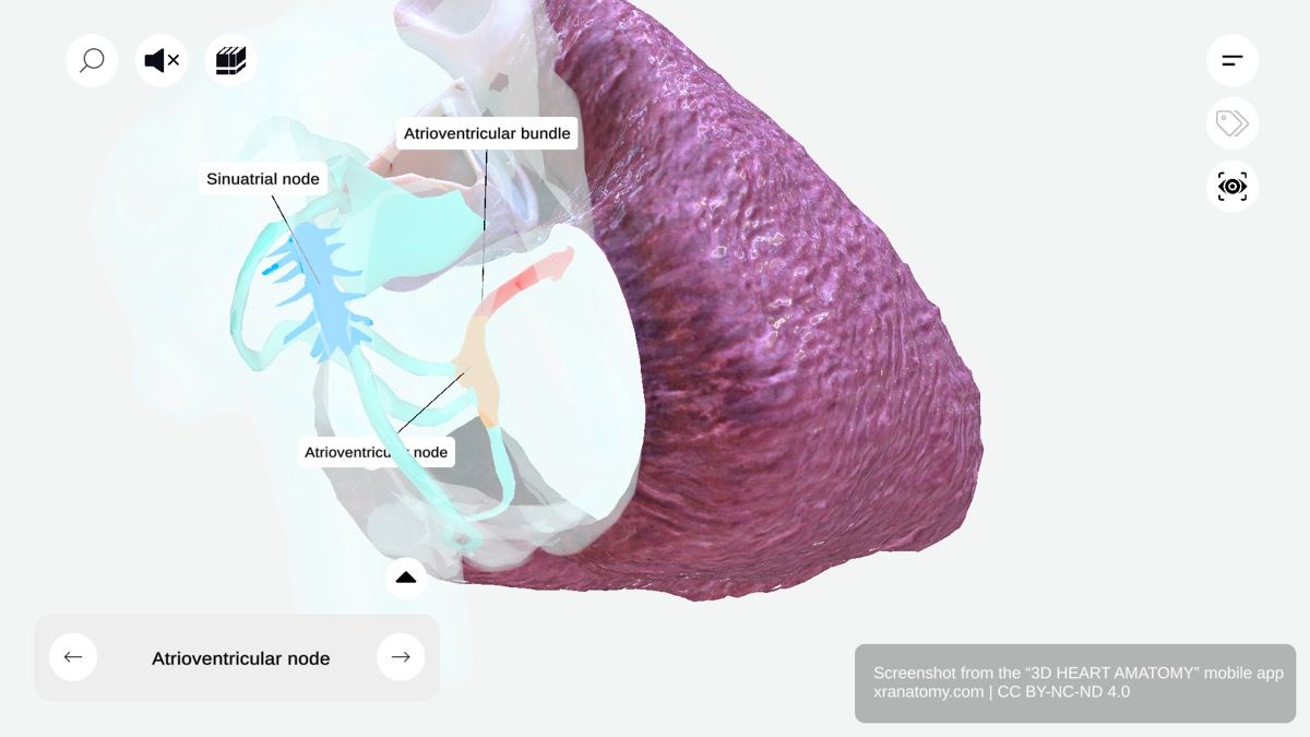 Atrioventricular node 360-degree viewer showing AV node within Triangle of Koch in right atrium near interatrial septum
