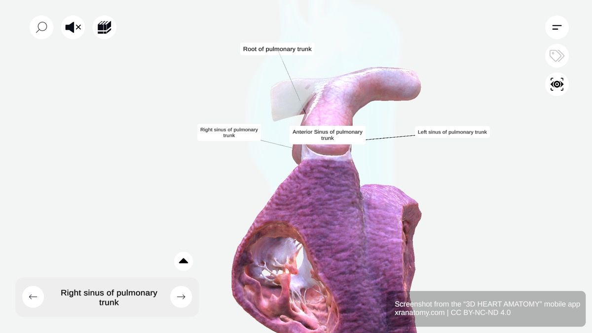 Sinuses of pulmonary trunk 360-degree interactive viewer showing right, left, and anterior sinuses