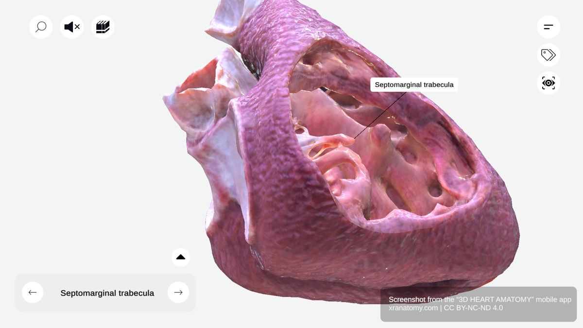 Septomarginal trabecula 360-degree interactive viewer showing moderator band with parietal and anterior limbs