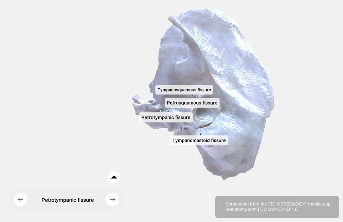 Temporal bone fissures 360-degree viewer showing petrotympanic, petrosquamous, tympanosquamous, and tympanomastoid fissures