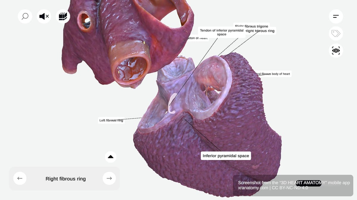 Inferior pyramidal space of the heart showing convergence of grooves and surrounding coronary vessels