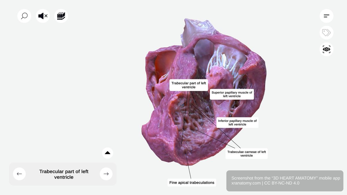 Trabecular part of left ventricle showing trabeculae carneae and fine apical trabeculations