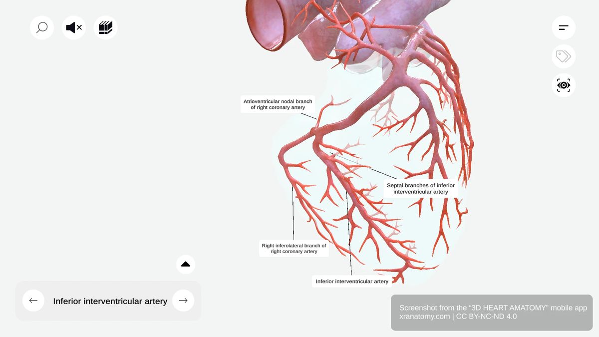 Inferior interventricular artery (posterior descending artery) running along inferior interventricular groove with septal branches