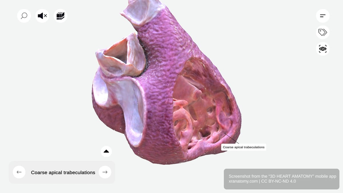 Coarse apical trabeculations of right ventricle showing robust muscle bundles at ventricular apex