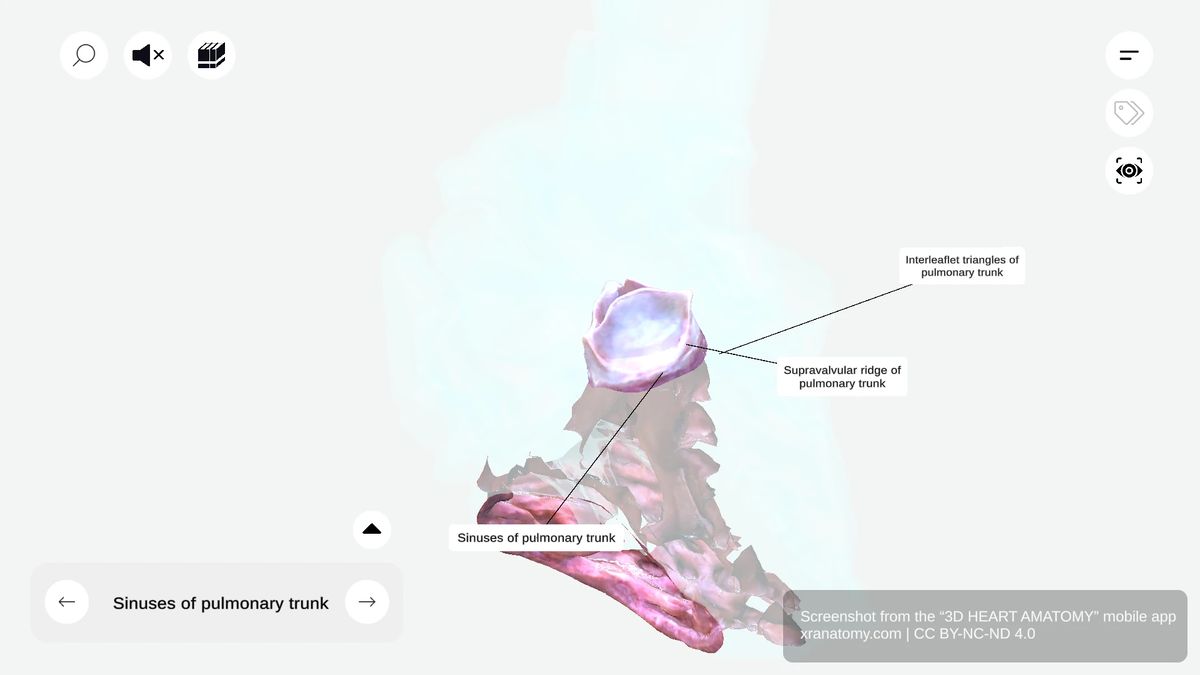 Interleaflet triangles of pulmonary trunk showing triangular areas between valve leaflet attachments