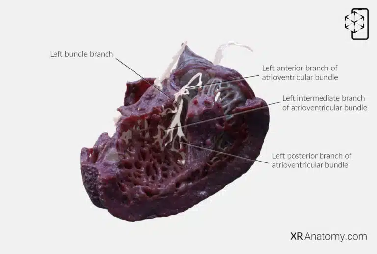 AR Figure 80 – Myocardium: Right bundle branch