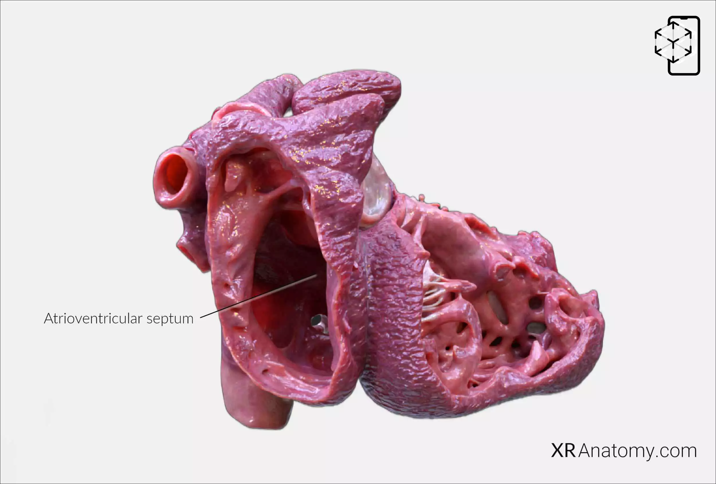 AR Figure 83 – Cardiac septa: Atrioventricular septum