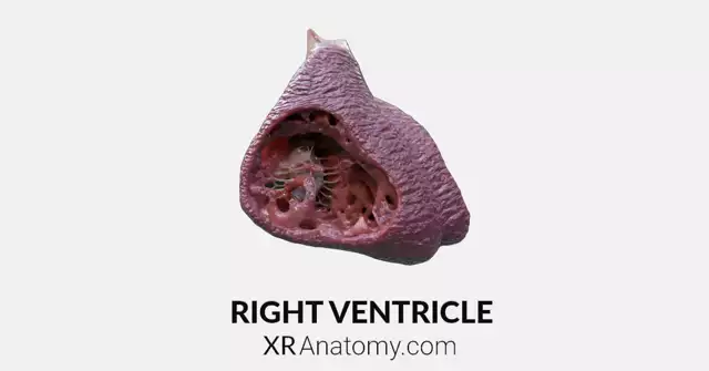 Right Ventricle AR