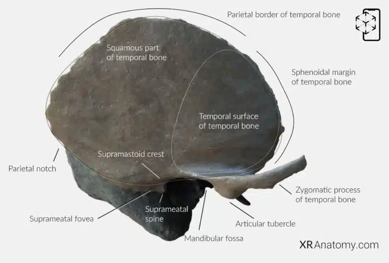 AR Figure 17 – Temporal Bone: Squamous Part