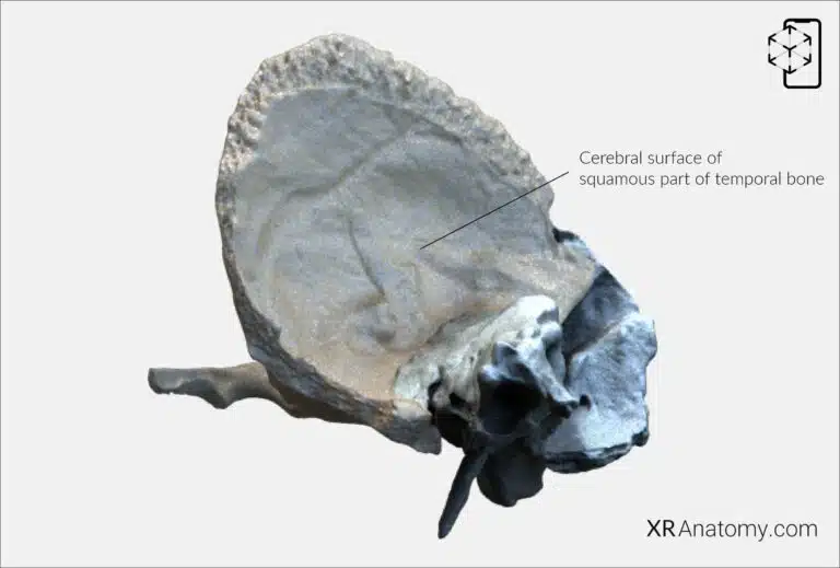 AR Figure 18 – Temporal Bone