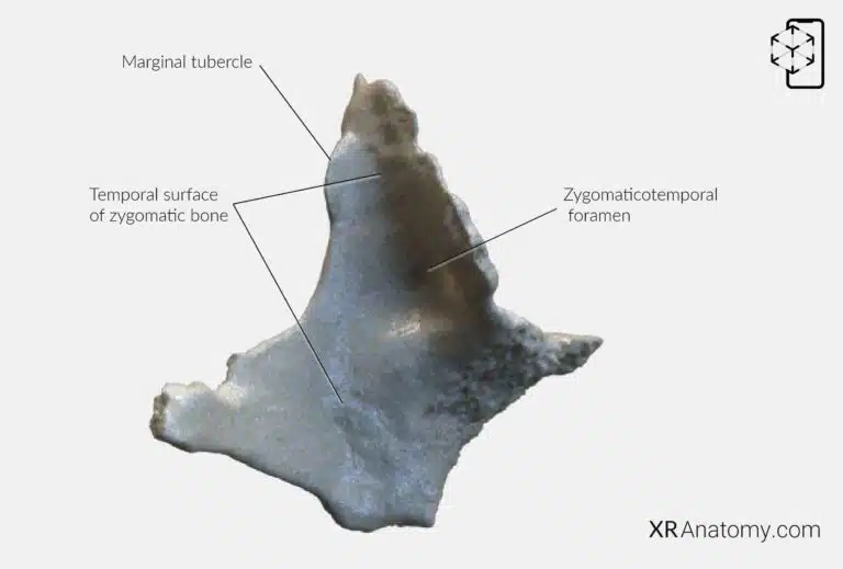 AR Figure 68 – Zygomatic bone: Posterior view