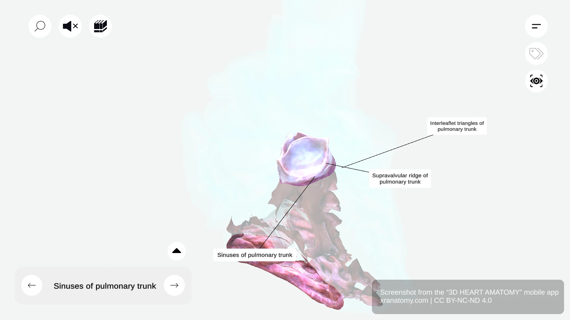 Interleaflet triangles of pulmonary trunk showing triangular areas between valve leaflet attachments